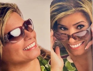 After treatment: custom-tinted porcelain veneers meticulously crafted to match the patient's natural complexion, demonstrating ideal translucency, lifelike vitality, and harmonious facial integration.